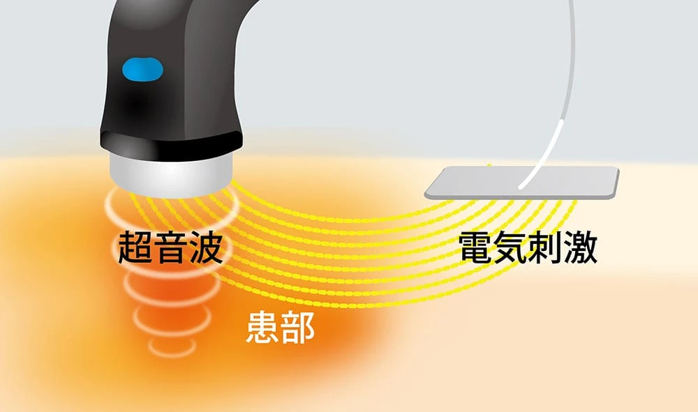 コンビネーション治療の説明図