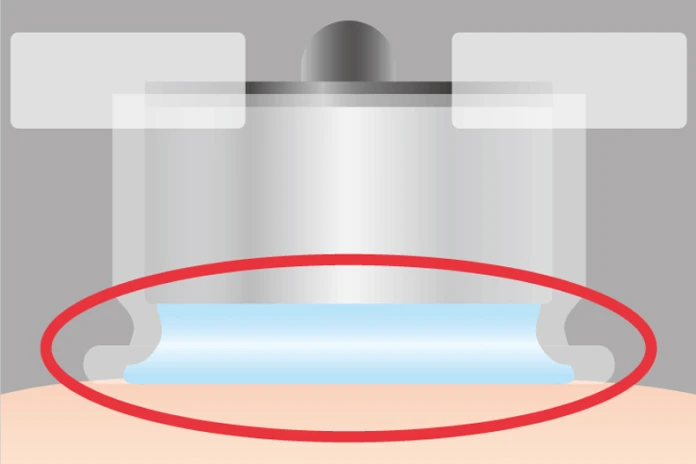 3Dリリースプローブ(Lサイズ)を頚部に使用している治療例