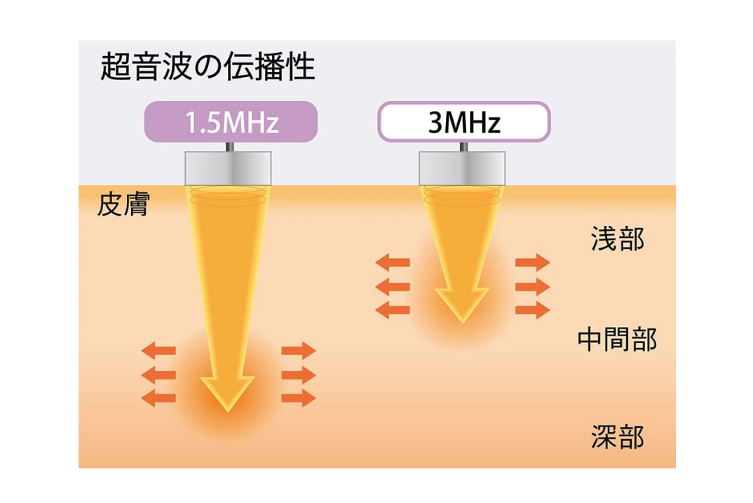 深部から浅部まで適切に対応する1.5MHz・3MHzプローブ